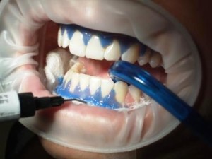 Sbiancamento dei denti - Dentax Studio